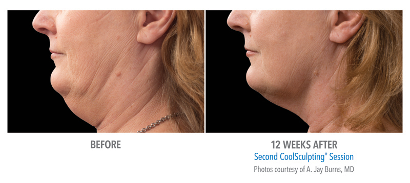 Chin and neck of woman before and after Coolsculpting treatment