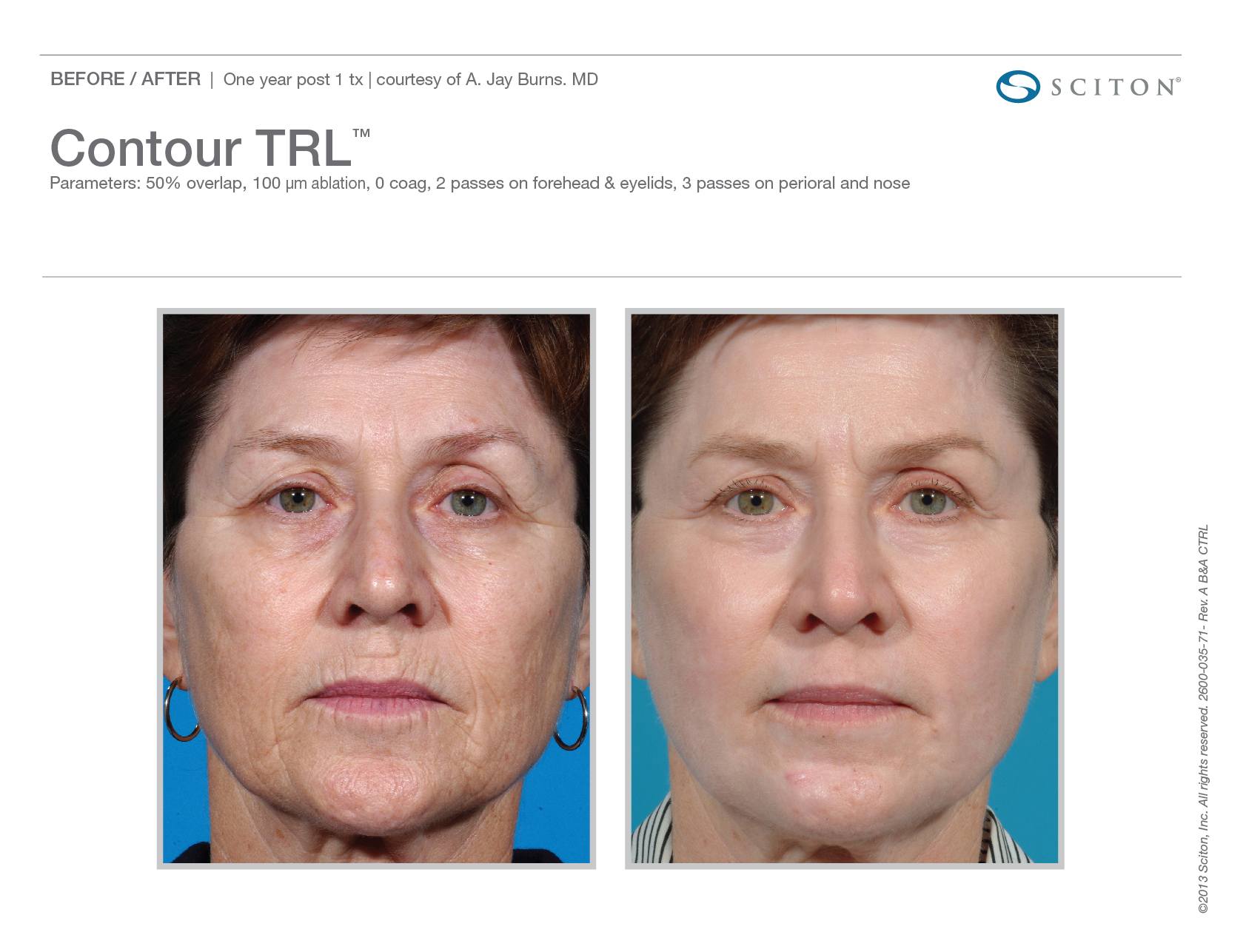 Contour TPL™ Before & After