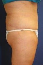Woman after tummy tuck